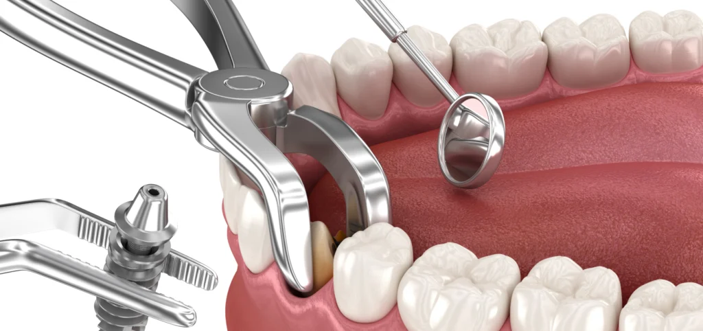extraction implantation Implantologie Cabinet dentaire Le 29 Bis | Chirurgiens-dentistes | Antony 92160