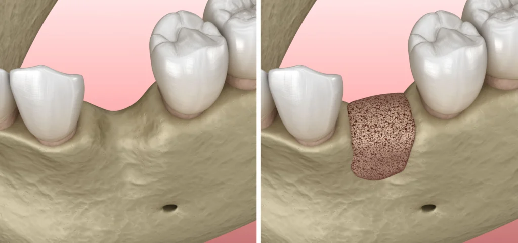greffes osseuses parodontologie chirurgicale Implantologie Cabinet dentaire Le 29 Bis | Chirurgiens-dentistes | Antony 92160