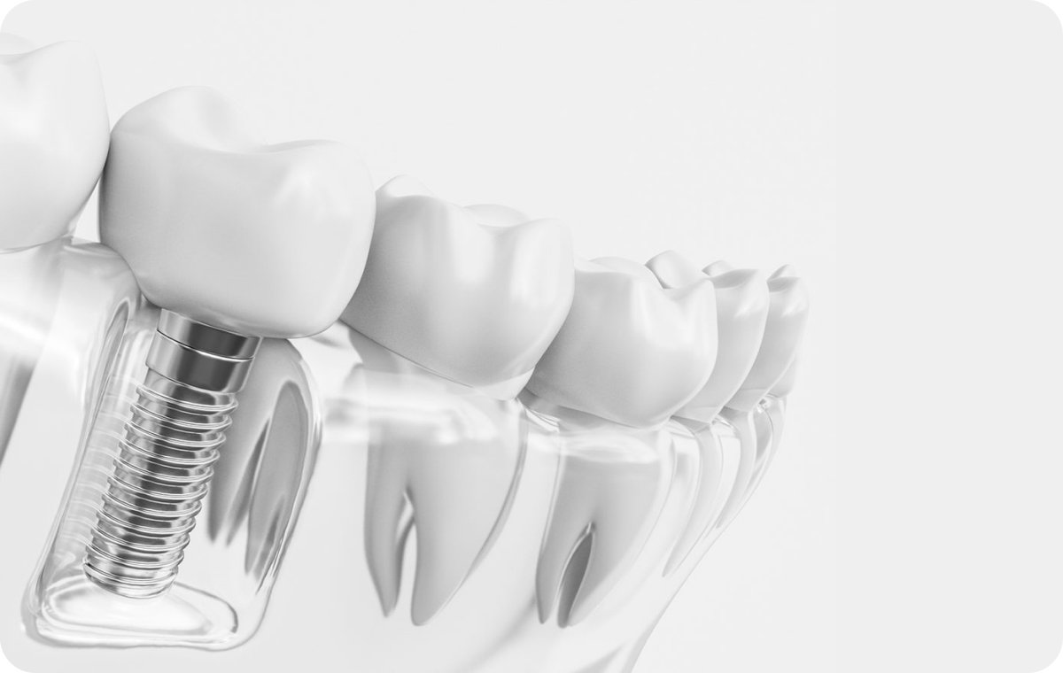implant dentaire Implantologie Cabinet dentaire Le 29 Bis | Chirurgiens-dentistes | Antony 92160