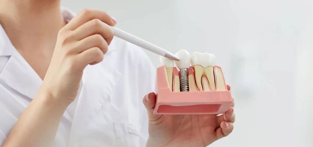 implant dentaire Implantologie Cabinet dentaire Le 29 Bis | Chirurgiens-dentistes | Antony 92160