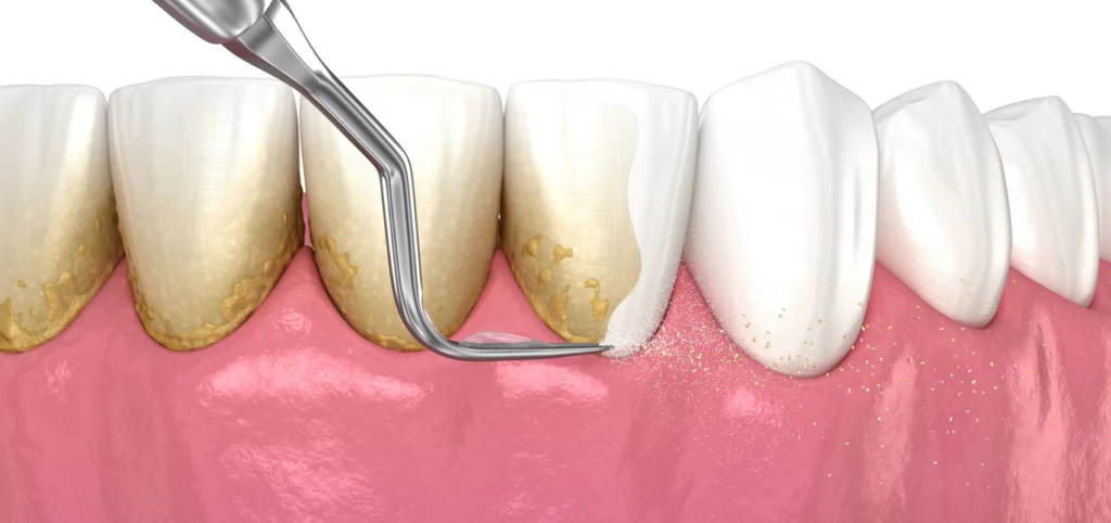 surfacage radiculaire detartrage Omnipratique Cabinet dentaire Le 29 Bis | Chirurgiens-dentistes | Antony 92160